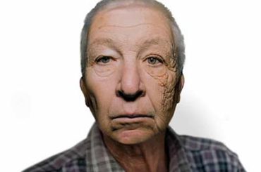 Envelhecimento Precoce